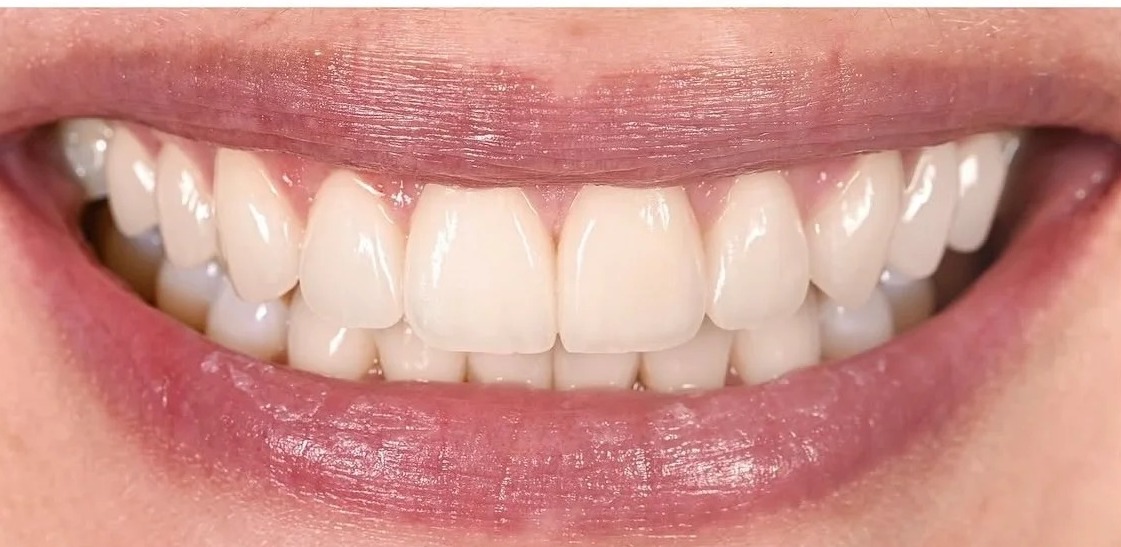 After: After treatment: artistic composite bonding used to repair localized structural damage, achieving an undetectable margin and perfectly mimicking the translucency and texture of the adjacent natural enamel.