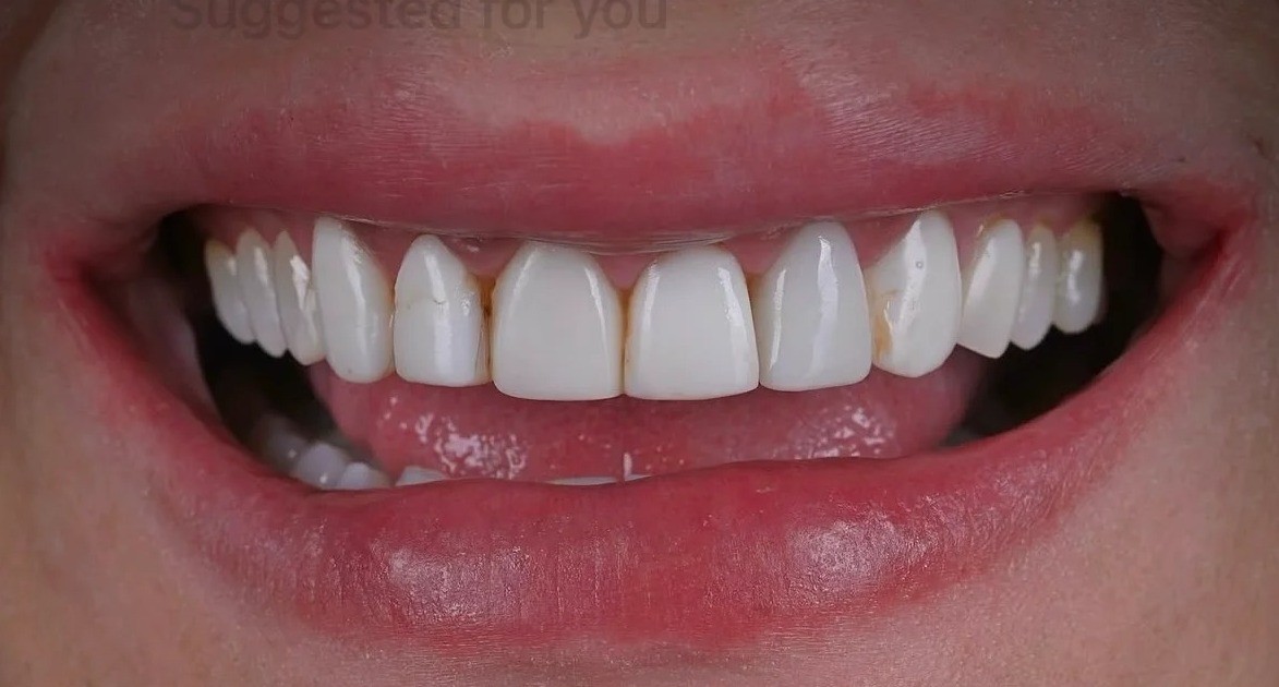 Before: Full transformation: before treatment, discoloration along the gumline and minor spacing detracted from the smile; after treatment, custom porcelain veneers delivered ideal length, subtle translucency, and natural vitality for a highly sophisticated aesthetic.