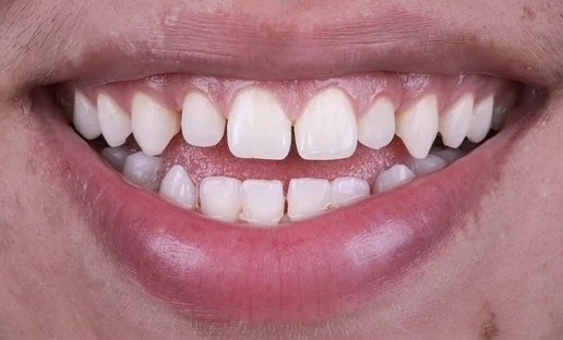 Before: Full transformation: before treatment, the smile lacked proper symmetry and exhibited age-related discoloration; after treatment, restorative cosmetic dentistry provided properly aligned, vibrant ceramic restorations with natural texture.