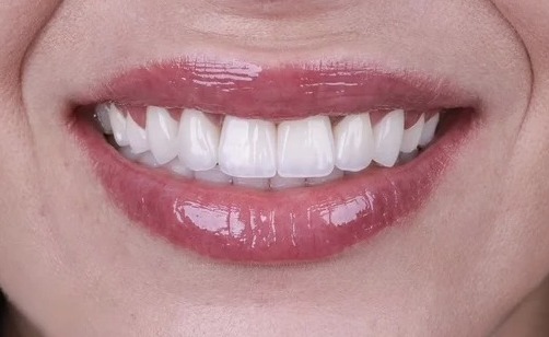 After: Full transformation: before treatment, the teeth exhibited significant wear, loss of vertical dimension, and yellowing; after treatment, a full-arch rehabilitation utilizing custom ceramic restorations completely restored proper function, symmetry, and vibrant aesthetics.