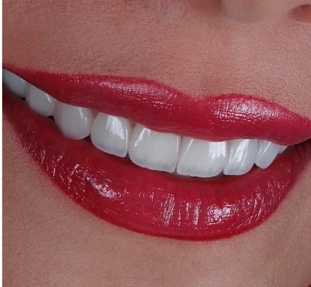 After treatment: a profile view showcasing the precise contouring and bright, lifelike translucency achieved following professional teeth whitening and conservative cosmetic reshaping.